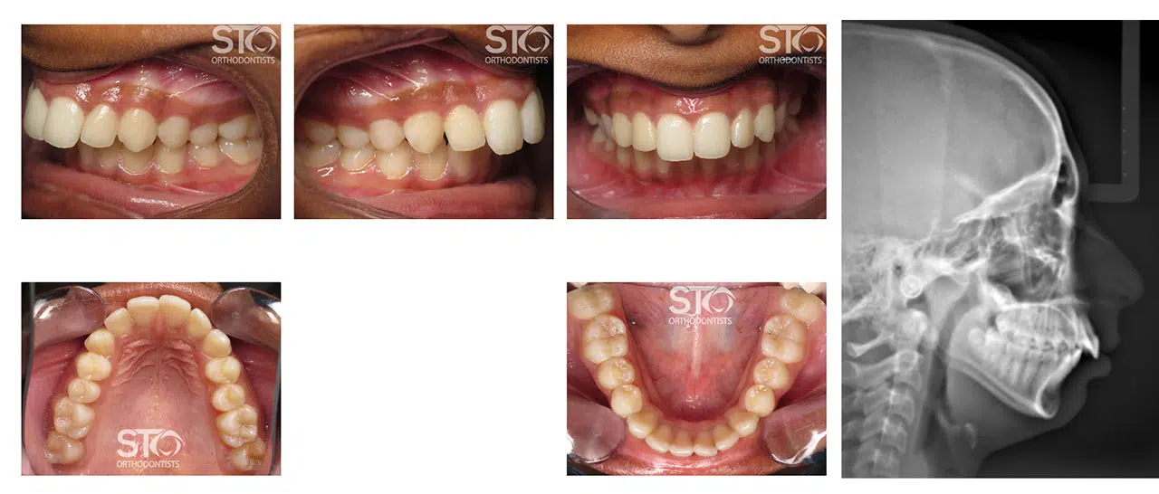 Beyond Straight Teeth: Addressing Bite Issues And Jaw Alignment For Optimal Oral Health In The Austin Metro Area